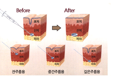 시술부위이미지