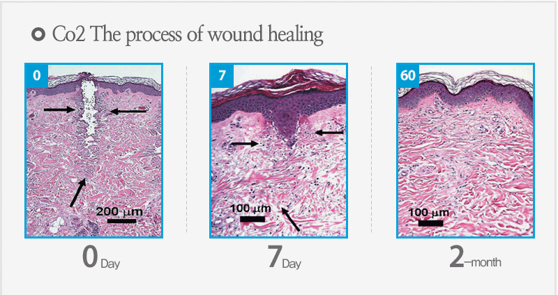 Co2 The process of wound healing